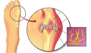 konieczność przestrzegania diety na dnę